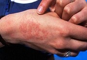 ۵۶۴ مبتلا به تب مالت در کردستان شناسایی شدند