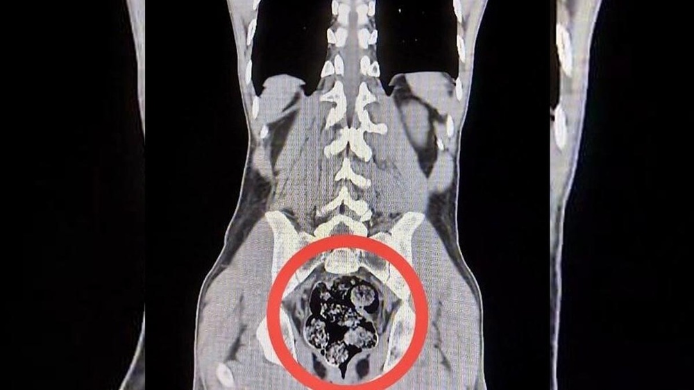 بازداشت دو شهروند ایرانی با محموله مواد مخدر در شکم در ترکیه