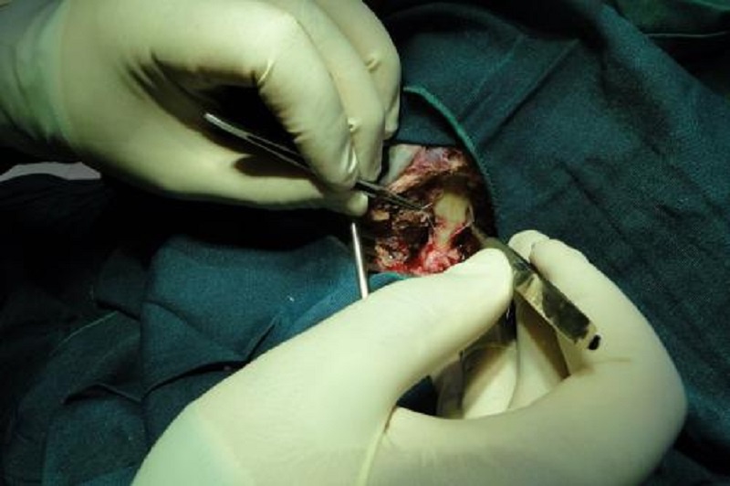 اولین عمل جراحی کیاری مالفورمیشن در کردستان انجام شد